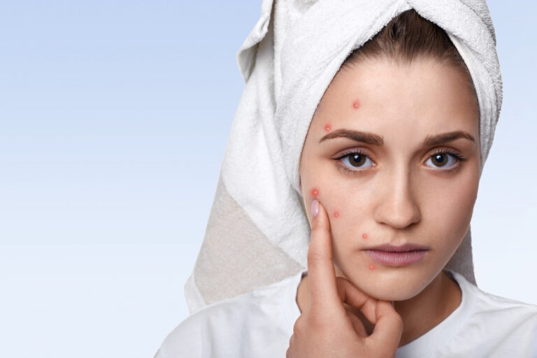 Azelaic acid vs Salicylic Acid: Which One is Best for You?